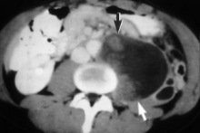Image from an abdominal CT scan showing a large tumor